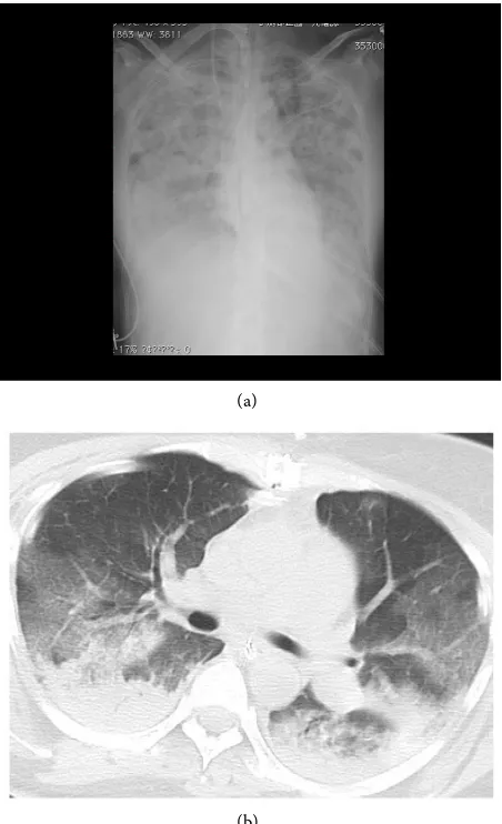 Figure 2. (a) Chest radiography performed in the operating room showing diffuse bila-teral pulmonary infiltrates; (b) Postoperative chest computed tomography scan showing bilateral gravitational atelectasis and peribronchial infiltrates but no pleural effu