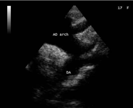 Figure 12. Apical view showing the dilated left ventricle and a normal left atrium in a 17-year old female in acute severe aortic regurgitation