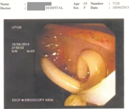 Fig. 2. Case 1. ERCP images showing round worm being 