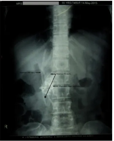 Fig. 5. Case 2. MRCP image showing dilated mid pancreatic duct  