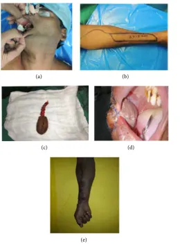 Figure 8. CT angiography of radial artery perforators. 