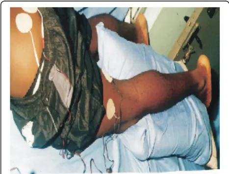 Fig. 2 Showing the second tens electrode placement of on the samesubject. The electrode was placed in such a way to cover the area ofpain perception