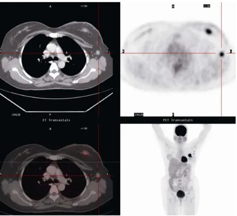 Figure 1. Pre chemotherapy fluorodeoxyglucose PET scan showing malignant disease in left breast and axilla