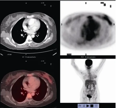 Figure 2. Post chemotherapy fluorodeoxyglucose PET scan showing residual disease in left breast and axilla