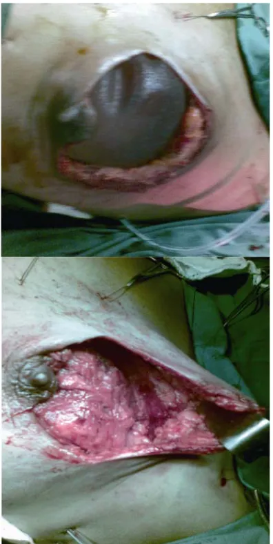 Figure 6. Latissimus dorsi flap in situ and placement of textured silicon implant underneath the flap