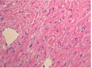 Figure 5. Final histopathological findings of the ovarian tumor. The tumor specimen shows fibroblasts and fibro-cytes (hematoxylin and eosin staining; original magnifi-cation, ×400)