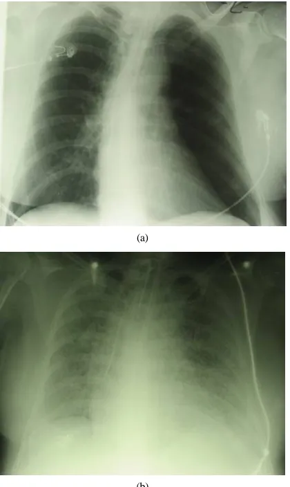 Figure 3. Obduktion following death at day 12: fibrosis of the whole parenchyma, signs for a beginning pneumonia