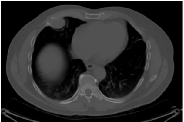 Figure 1. Axial CT of the chest using bone windows demonstrates a 2.8 × 3.8 × 2.9 cm soft tissue right chest wall mass involving the right anterior fifth rib