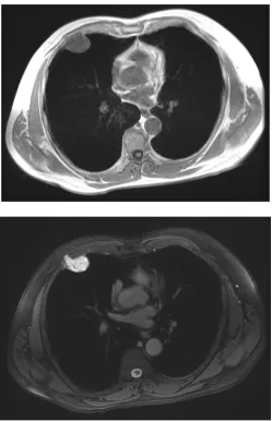 Figure 3. Diffusion weighted imaging (DWI) of the anterior chest wall mass shows hyperintense signal with corresponding hypointense signal on apparent diffusion imaging (ADC) shown in Figure 4, which indicates with the high cellularity of the tumor