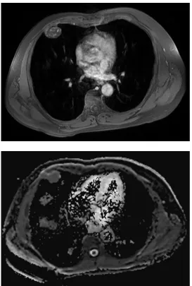 Figure 5. Axial fused PET/CT image at the level of the lower chest shows a soft tissue mass with osseous destruction of the anterior fifth rib with a maximum standard uptake value (SUV) of 1.9