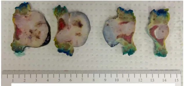 Figure 6. Gross pathology of the resected right fifth rib revealed a firm, oval, tan-white colored 3.7 × 3.3 × 3.2 cm solid mass