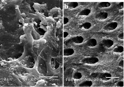 Figure 6. a, b. Optimized canal preparation 6. a, b. Optimized canal preparation with appropriate taper and appropriate coronal access.taper and appropriate coronal access