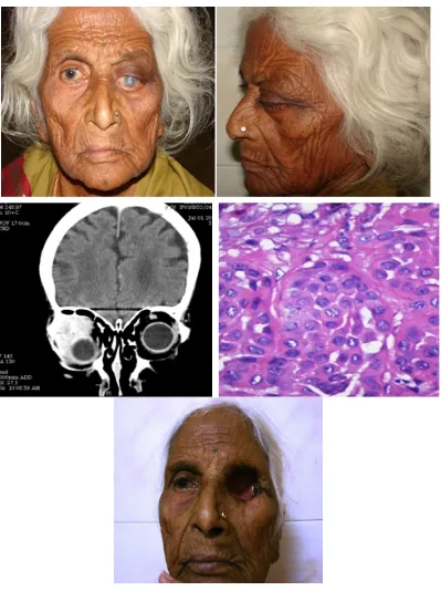 Fig. 2. Muco-epidermoid carcinoma of Lacrimal gland 