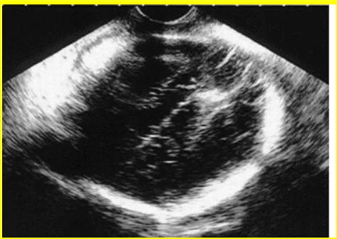 Fig. 11. Ultrasound image of cervical effacement