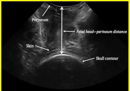 Fig. 15.Ultrasound image of how to measure fetal head perineum distance 