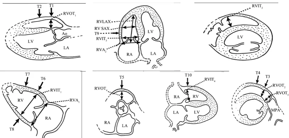 Figure 1. Scheme of different diameters of the right ventricle. 