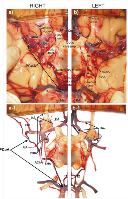 Figure 2. Unusual origin and termination of the right posterior communicating artery associated with persistent olfactory artery remnant