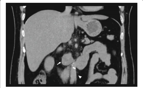 Fig. 1 Coronal noncontrast computed tomography image. Aheterogeneous mass in the right retroperitoneal region (white arrow)adjunct to the inferior vena cava (white arrow head) is demonstrated