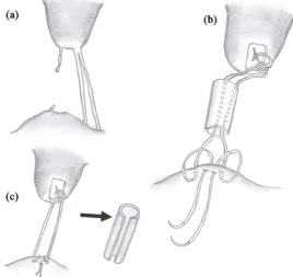 Figure 1. Mitral valve repair with insertion of artificial chordae. (a) The basal chordae of and fixed to the prolapsing leaflet, following which the tube was removed (Gray arrow).was attached to the prolapsing posterior leaflet; (c) The CV-5 Gore-Tex sutu