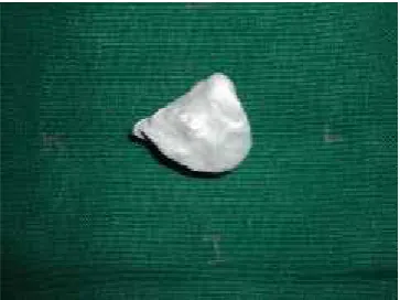 Figure 1. Patient with enucleated right eye