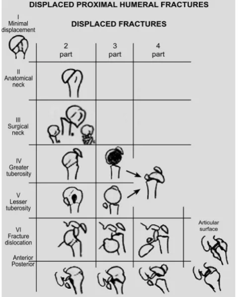 Figure 1. The Neer classification for proximal humerus fractures [5]. 