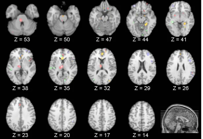 Table 3. Results of included PET studies investigating regional brain activity during NREM sleep compared to wakefulness
