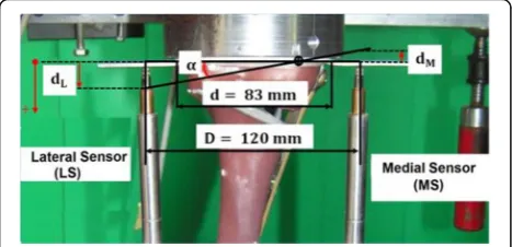 Fig. 3 Valgus-malrotation of the tibia head. The lateral displacementdL was assumed positive and the medial displacement dM wasassumed negative