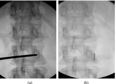 Figure 3. (a) Segmental muscle spasm and mild scoliosis at the involved level; (b) After dorsal ramus injection: the segmental muscle spasm and mild scoliosis resolved