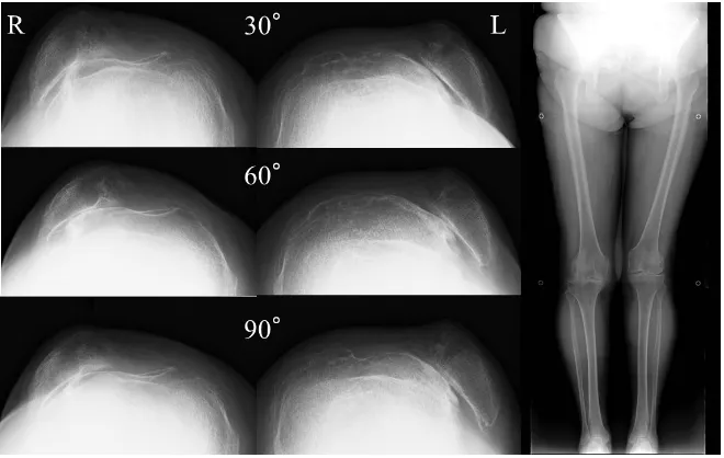 Figure 1. Preoperative radiographs: Skyline radiographs demonstrated complete disloca-tion of the patella