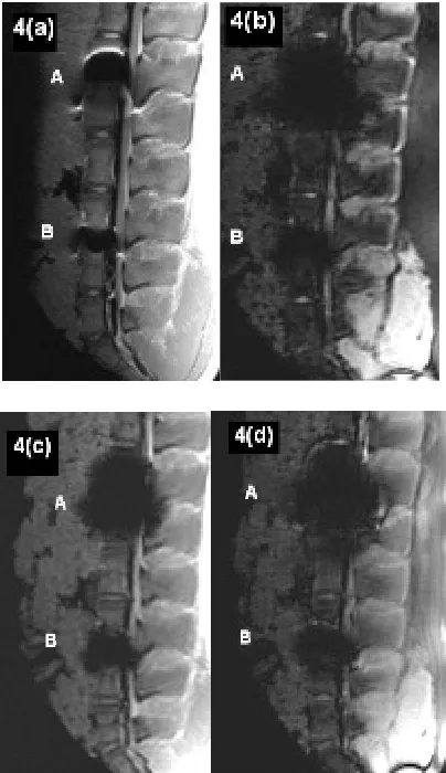 Figure 4.(a)-(d) Artifact range considering different MRI- sequences. A: Cobalt-chromium-intervertebral disc dowel; B: IBS-titanium-spacer
