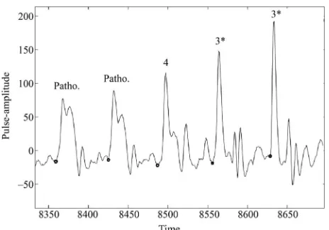 Figure 3. Automatic prediction of pulse-morphology over time sive period shown here is predicted as II, which is correct ac-for pulse record (from time point 300 to 900 in units of 0.01 seconds) of subject code no