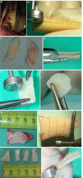 Figure 2. WT, the donor site and the wedge preparation. (a) Bone block harvest from the left retromolar area