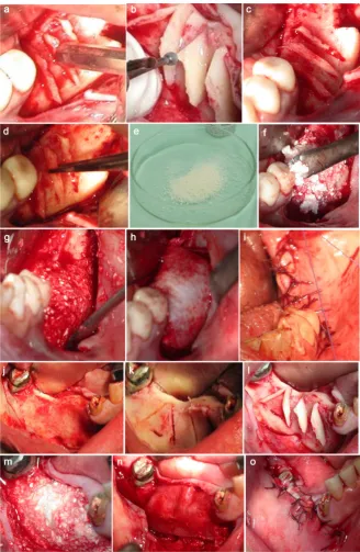 Figure 4. WT, Bone augmentation. (a) Inserting and tapping of the wedges inside the grooves