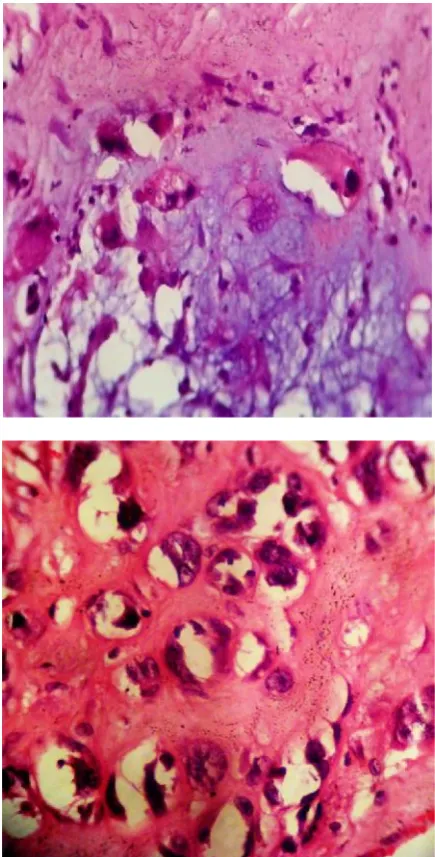 Fig. 6. Impression: cytokeratin and vimentin positivity for chordomas