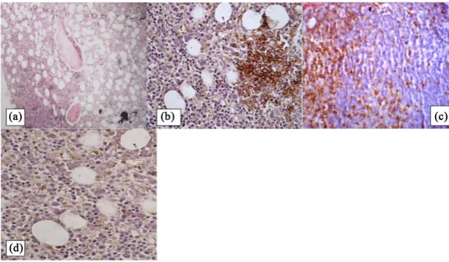 Figure 1. A case of B-NHL showing no obvious lymphoid infiltration in H & E (×10). (a) Positive patchy CD20 (×10); (b) Positive interstitial CD20 (×10); (c) Negative CD3 (×10); (d) Occult malignant lymphoid infiltration