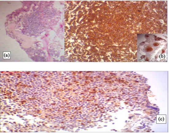 Table 3. Discrepancy between patterns of infiltration in both H/E versus IHC. 