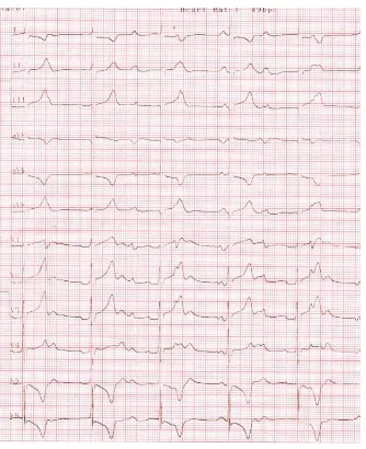 Figure 11. ECG showing complete heart block (heart rate 50 bpm) in a 4 –year old female child