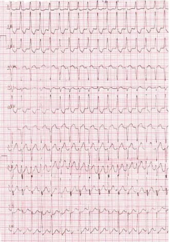 Figure 1. Showing narrow QRS tachycardia. 