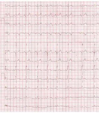 Figure 6. ECG normalizing after 5 days course of heparin therapy. 