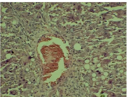 Fig. 4. mild to moderate degree fatty changes with mild infiltration of inflammatory cells  