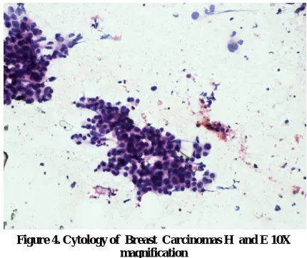 Figure 4. Cytology of  Breast  Carcinomas H  and E 10X 