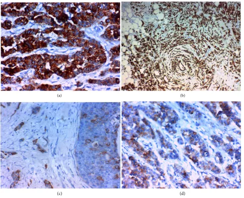 Figure 2. Immunohistochemical staining of YKL-40 in invasive carcinoma of the breast: (a) High cytoplasmic expression in high grade invasive duct carcinoma of the breast (NOS) stage IV×400; (b) High cytoplasmic expression in high grade invasive lobular car