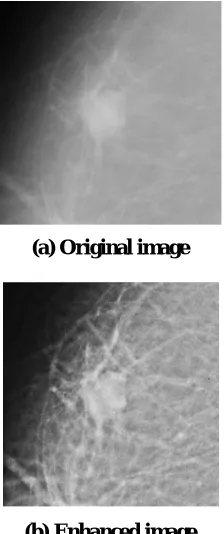 Fig. 6. Resultant Enhanced mammogram image Obtained by nonsubsampled contourlet transform 