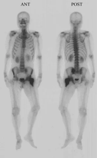 Figure 4. A 99mTc-methylene diphosphonate scintigraph showing a diffuse uptake in the left proximal femur