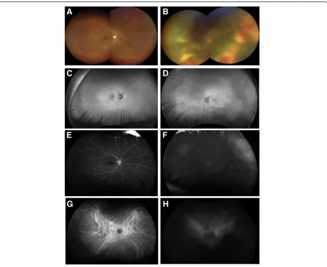 Fig. 1 Fundus photographs, fundus autofluorescence, fluorescein angiography, and indocyanine green angiography of both eyes