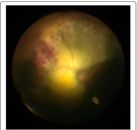 Fig. 3 Intraoperative photo of diagnostic pars plana vitrectomy ofthe left eye. Intraoperatively, a large exudative retinal detachmentwith significant subretinal yellow-white deposits, sclerotic vessels,and intraretinal hemorrhages was noted