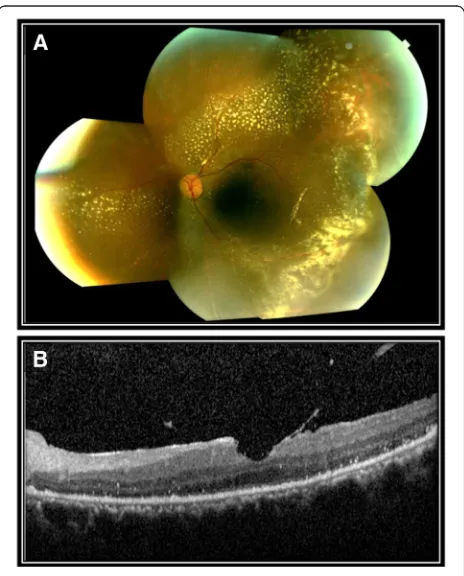 Fig. 6 Post-operative fundus photography and optical coherencetomography of the left eye
