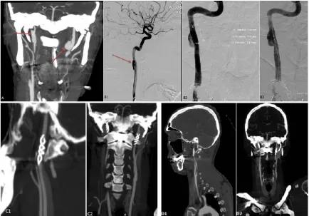 Figure 2. Images of patient #5 in table #1. (A) CT angio, showing a large long standing pseudoaneurysm in a tortuous Right ICA; (B) Angiography, Stent placement ×2