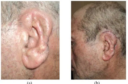 Figure 3. Second stage of the procedure. (a) 6 weeks after the first stage; (b) Post auricular skin incision and final result