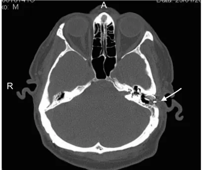Figure 1. MRI scan (coronal view) of the patient prior the lesion at the right ear is larger than the one at the to first surgery to remove the vestibular schwannoma on the right ear